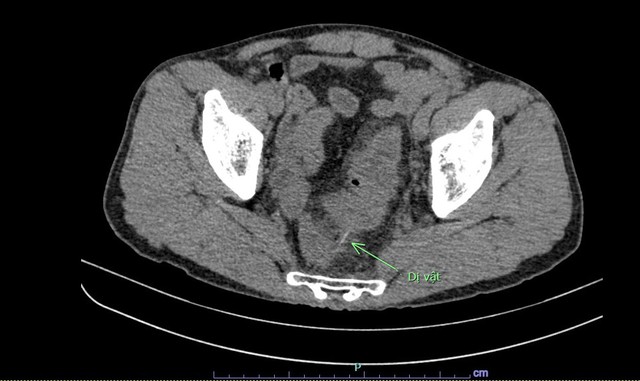 Tăm tre 10 cm đâm thủng đại tràng - Ảnh 1.