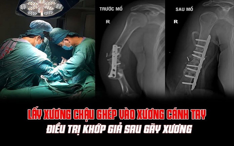 Phú Thọ: Trung tâm Y tế huyện Cẩm Khê phẫu thuật thành công ca ghép xương điều trị khớp giả
